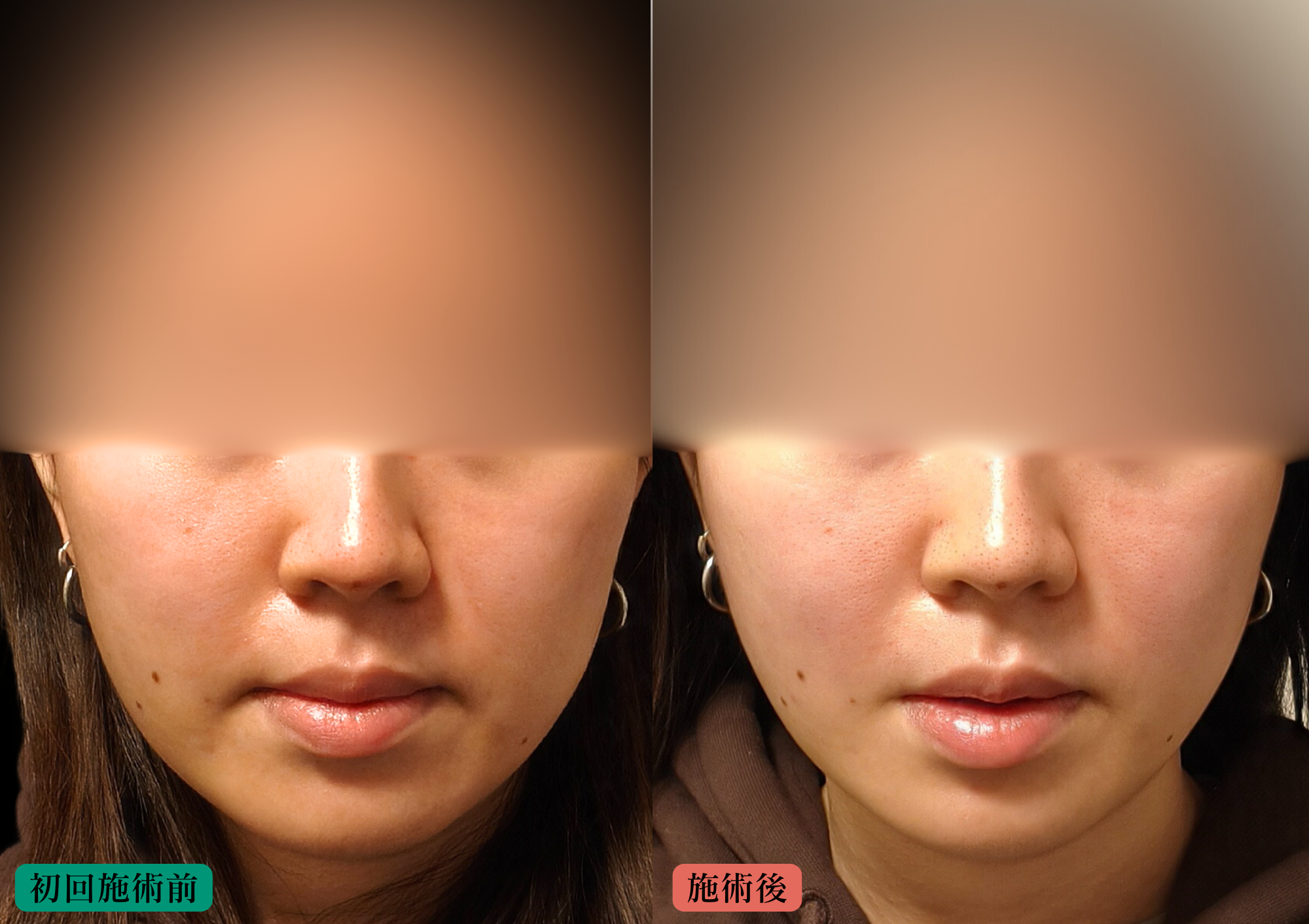 食いしばりによるエラ張りに対する美容鍼施術の経過