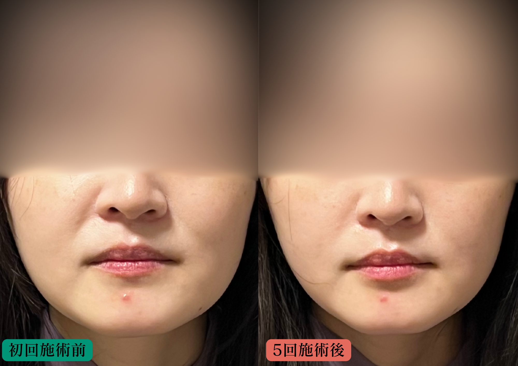 美容鍼+LEDでの施術前後での比較