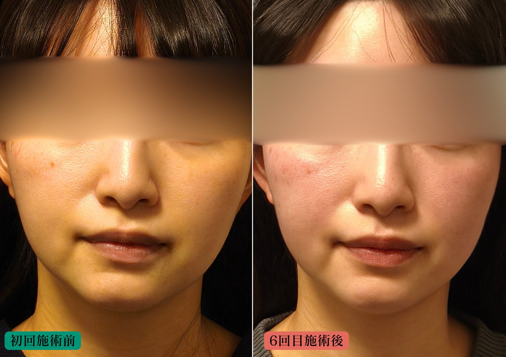 やなけんの美容鍼+LEDでの経過（30代女性）