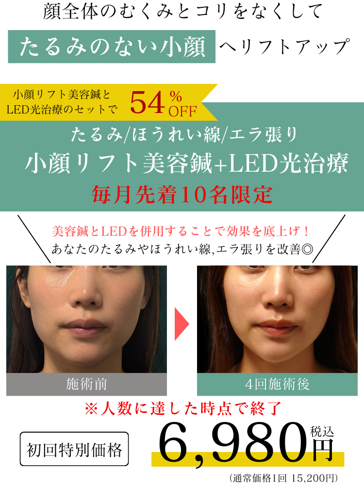 たるみ、ほうれい線、むくみを改善する美容鍼の初回オファー