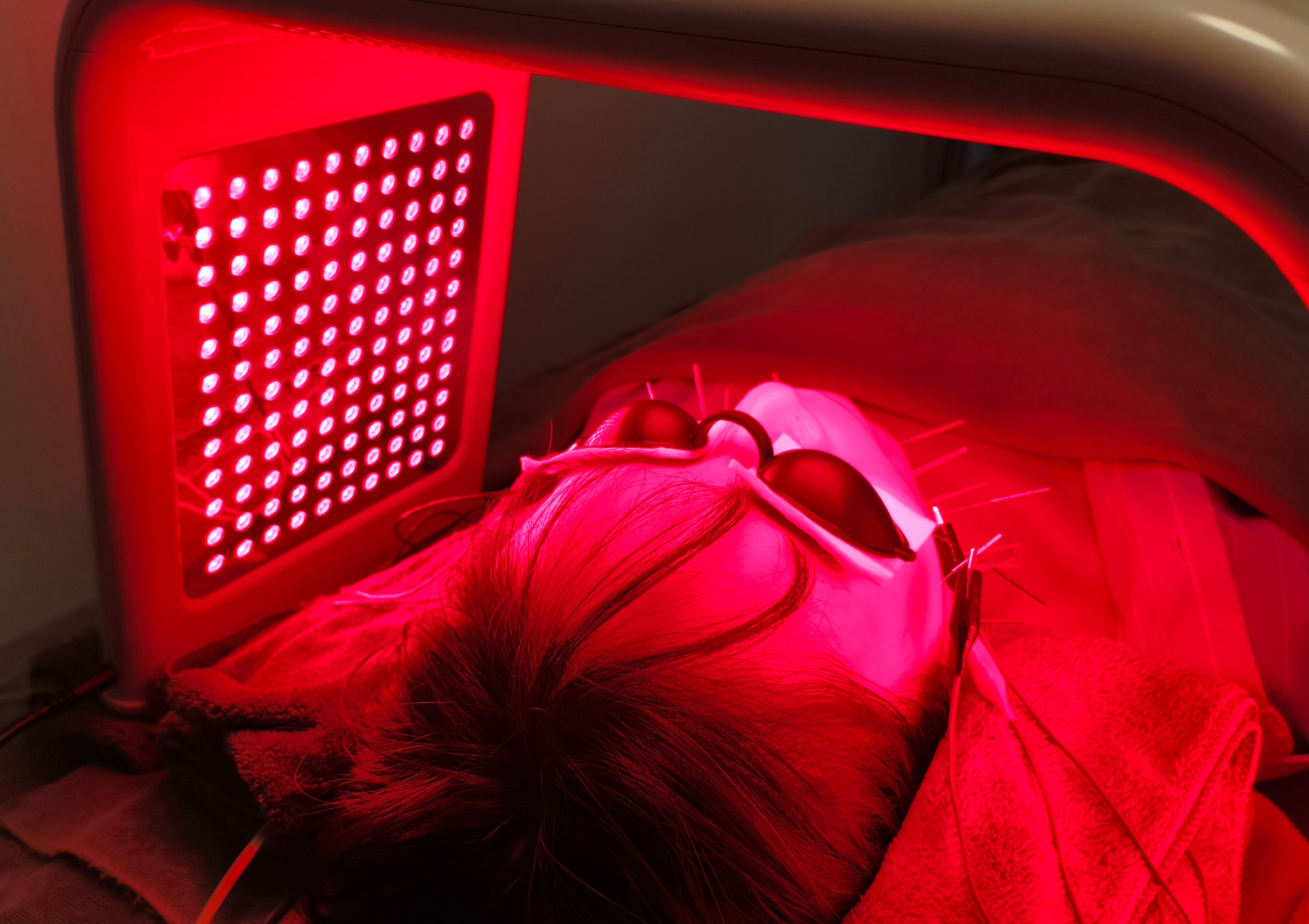 亀戸にある鍼灸サロンやなけんの美容鍼+LED+IR