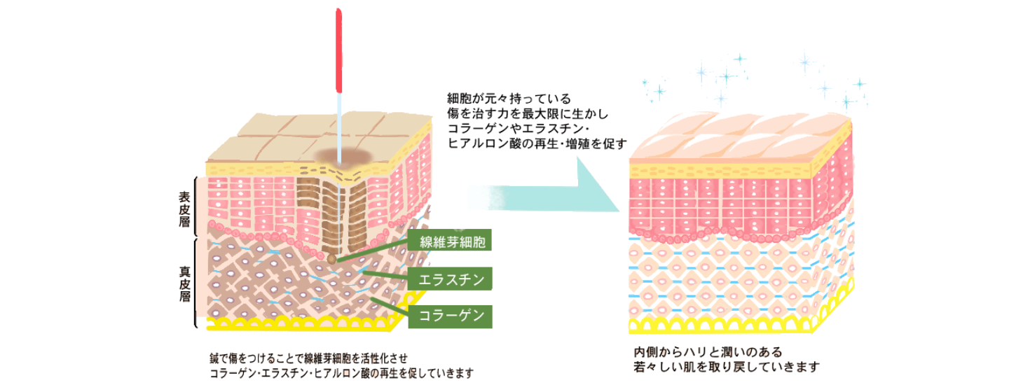 亀戸の鍼灸サロンやなけんの美容鍼でコラーゲンが増える説明の画像
