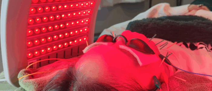 亀戸にある鍼灸サロンやなけんの小顔リフト美容鍼+LED（赤色）
