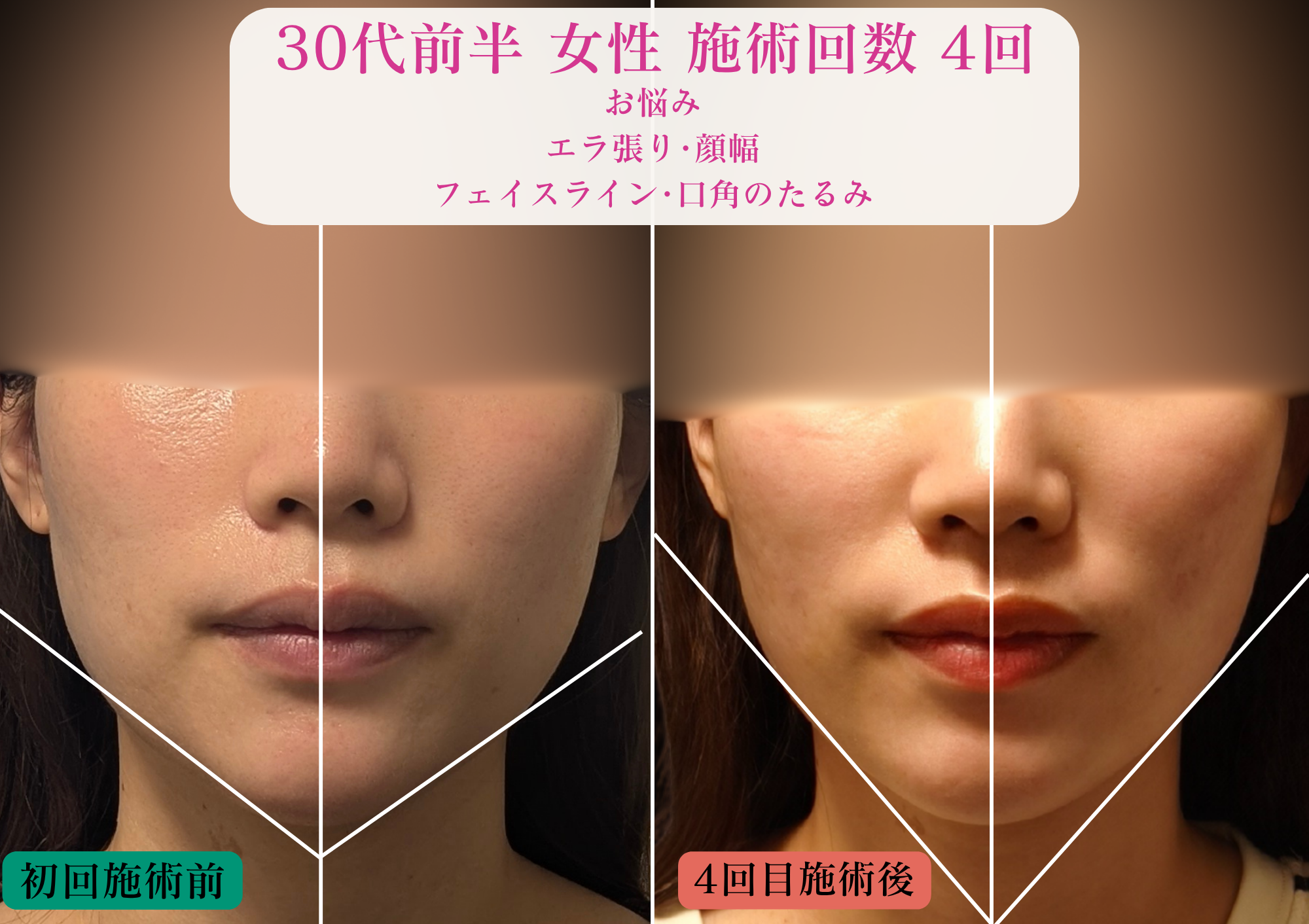 亀戸の鍼灸サロンやなけんの美容鍼を受けたエラ張り、フェイスラインに悩む30代女性の施術前後の比較