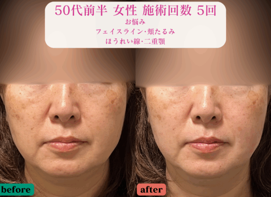 フェイスライン、頬のたるみ、ほうれい線に悩む50代女性の美容鍼施術による前後比較