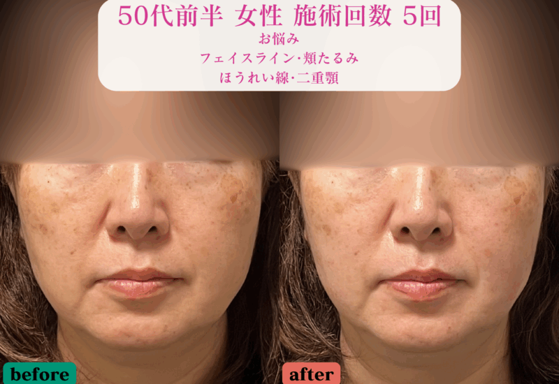 フェイスライン、頬のたるみ、ほうれい線に悩む50代女性の美容鍼施術による前後比較