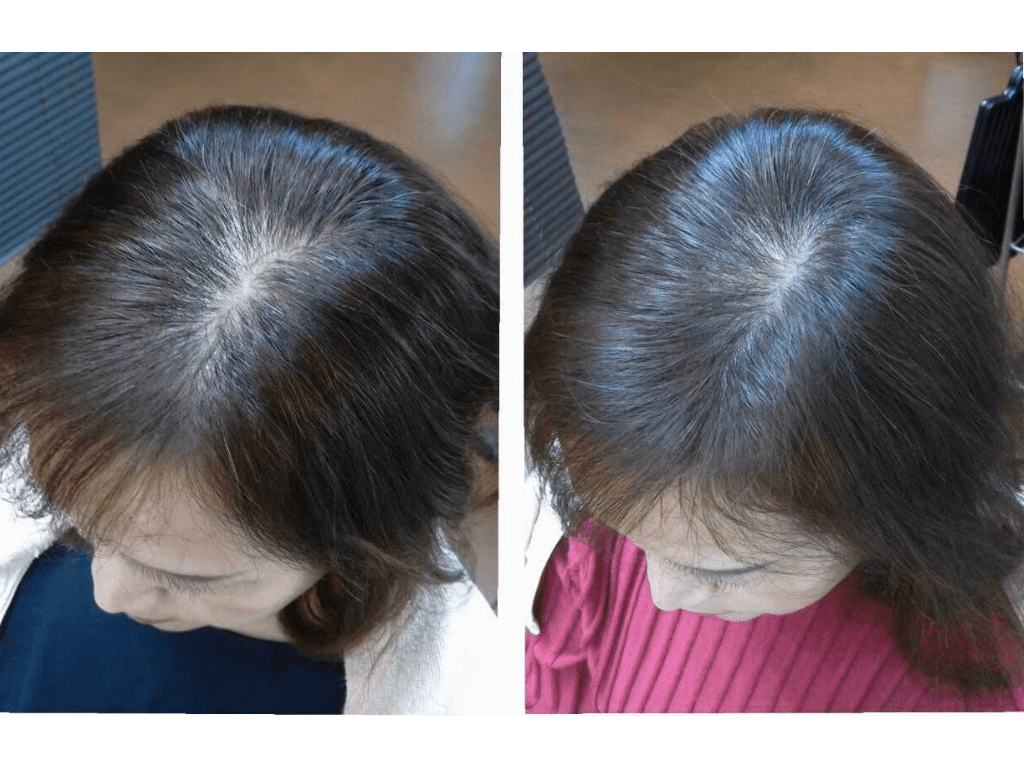 亀戸にある鍼灸サロンやなけんの薄毛施術