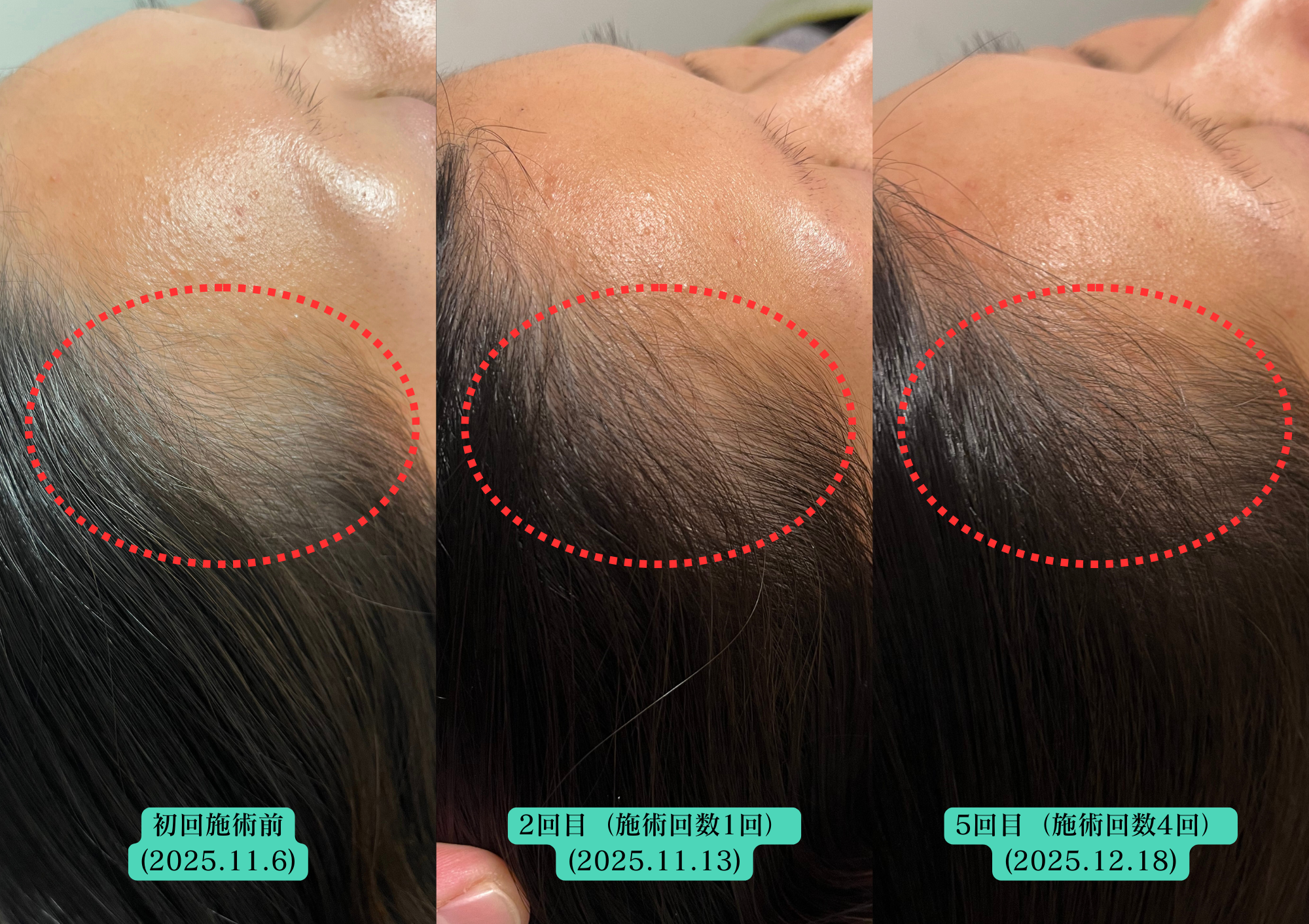 薄毛改善、育毛、発毛のお悩みにはやなけん亀戸店の育毛鍼