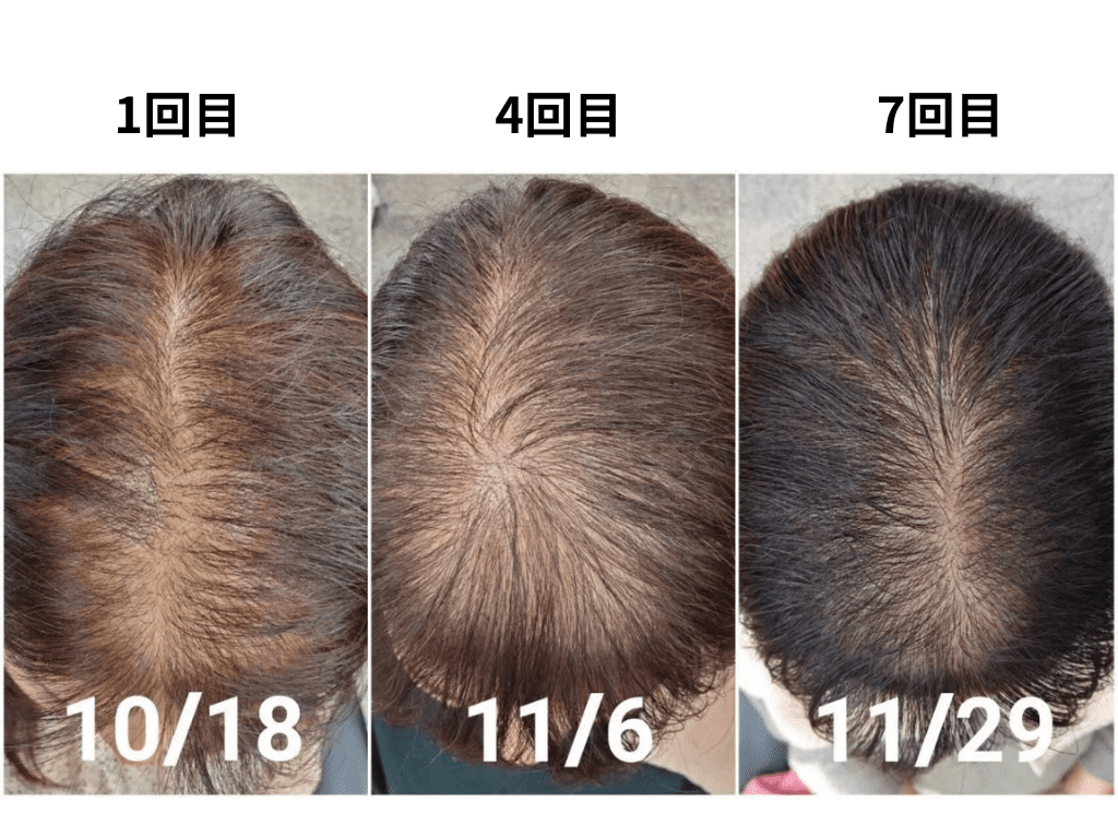 亀戸にある鍼灸サロンやなけんの薄毛に対する育毛鍼