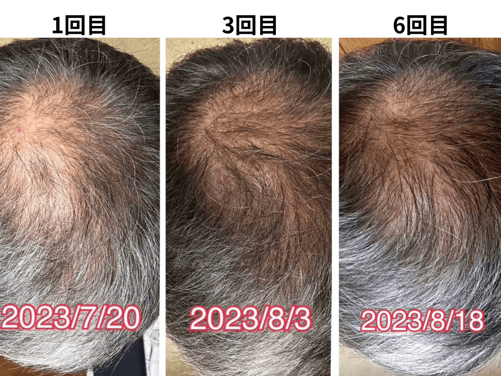 亀戸にある鍼灸サロンやなけんの男性の薄毛施術