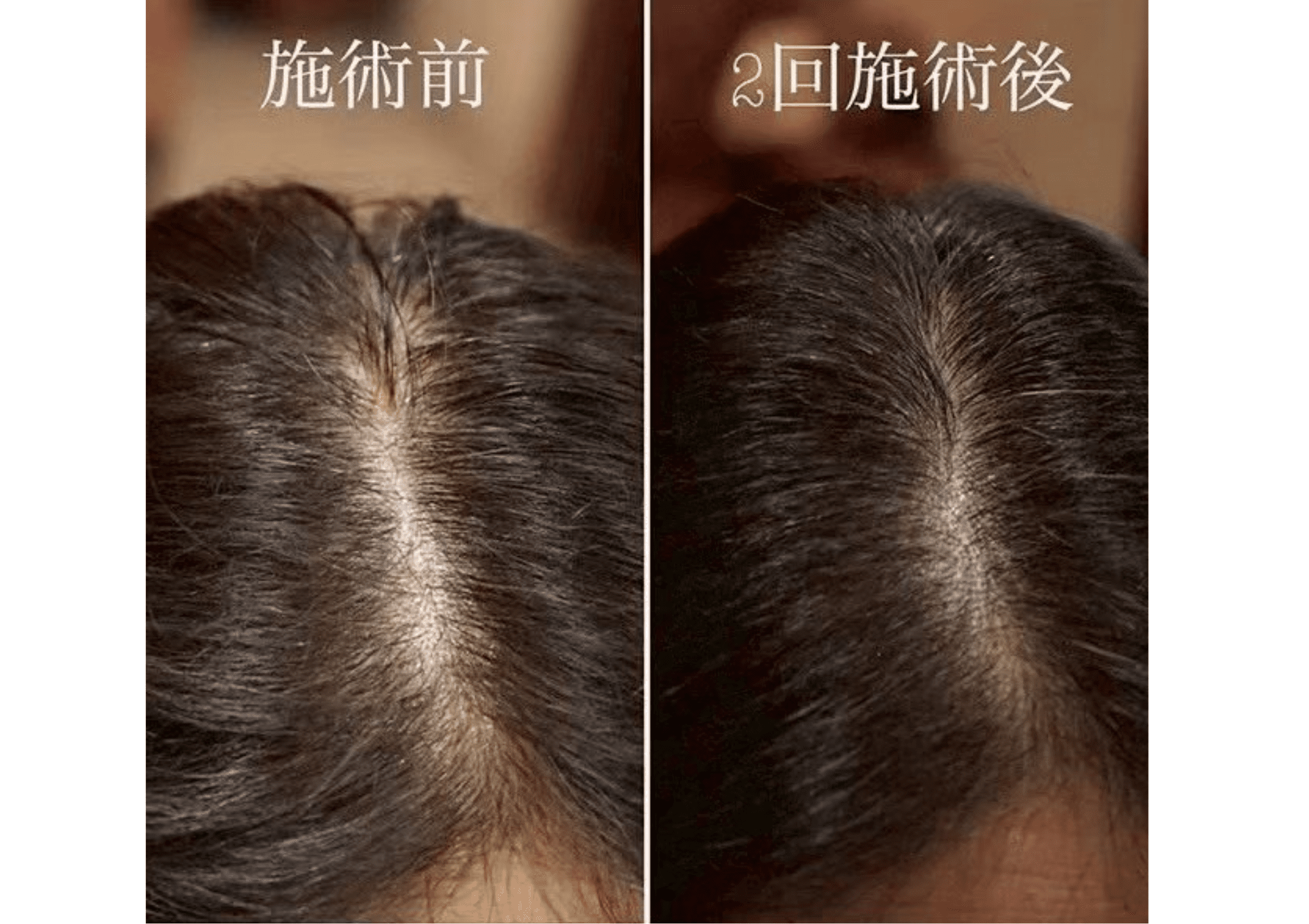 亀戸にある鍼灸サロンやなけんの薄毛施術育毛鍼