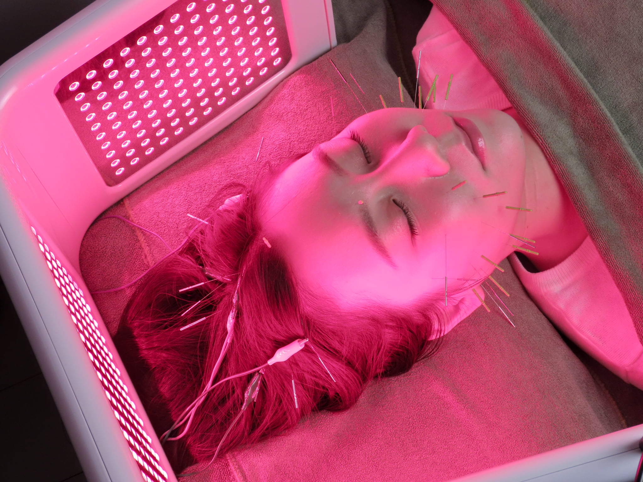 亀戸にある鍼灸サロンやなけんの薄毛施術の画像