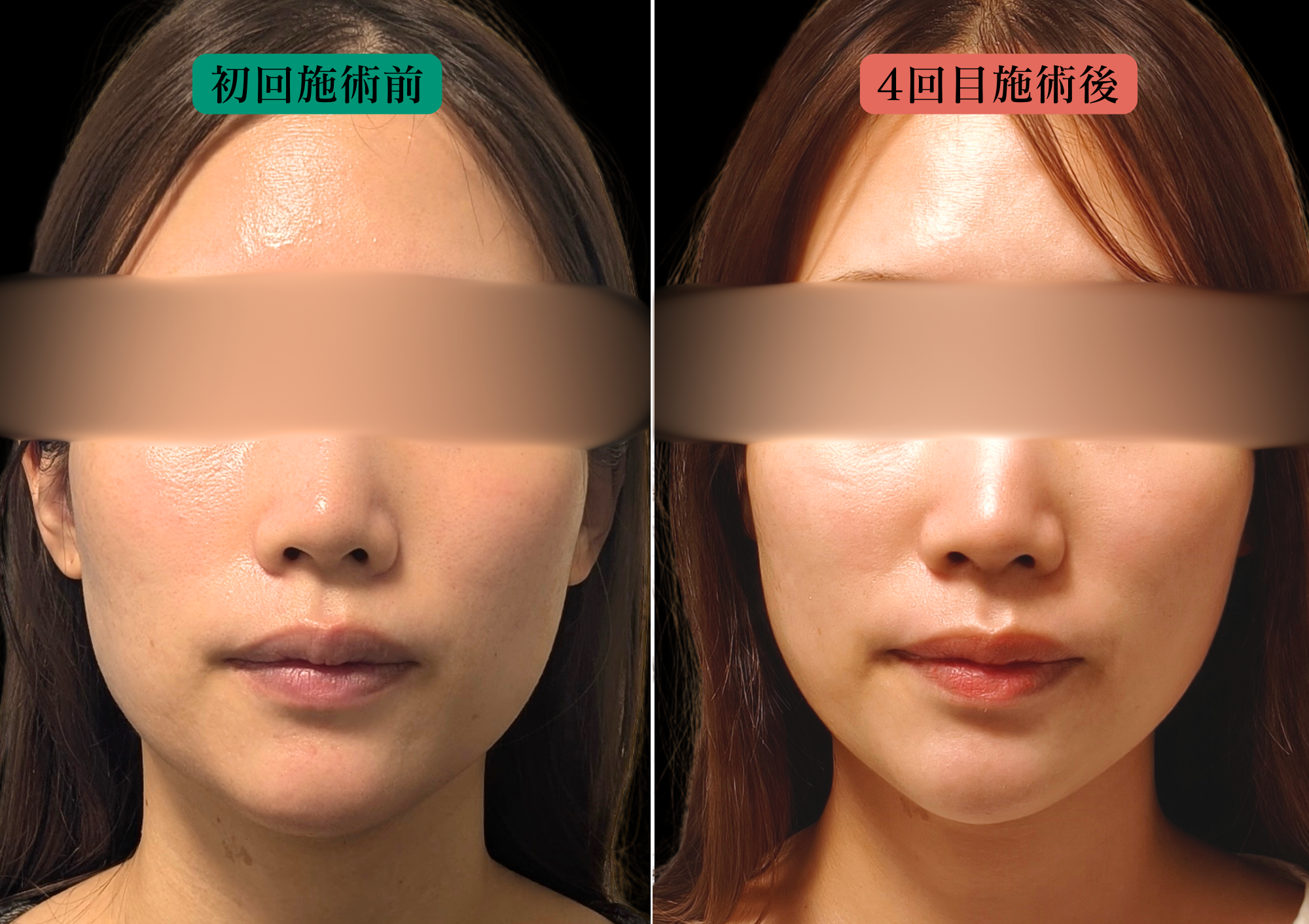 鍼灸サロンやなけん亀戸店の美容鍼での経過