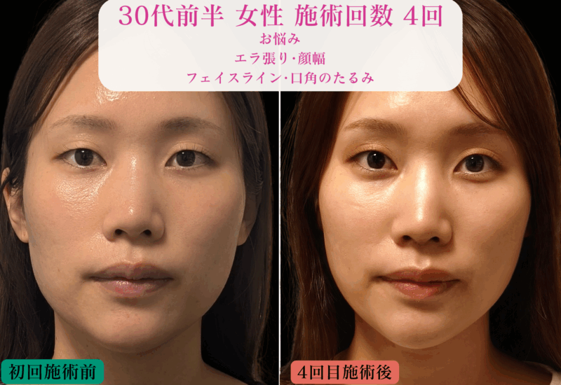 亀戸にある鍼灸サロンやなけんの美容鍼+LEDでの変化