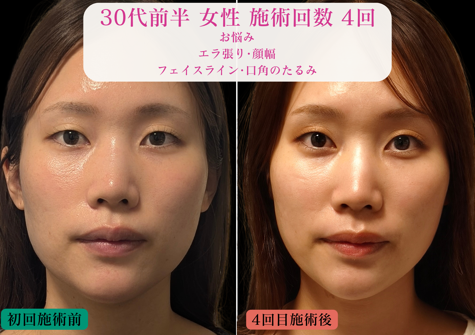 亀戸にある鍼灸サロンやなけんの美容鍼+LEDでの変化