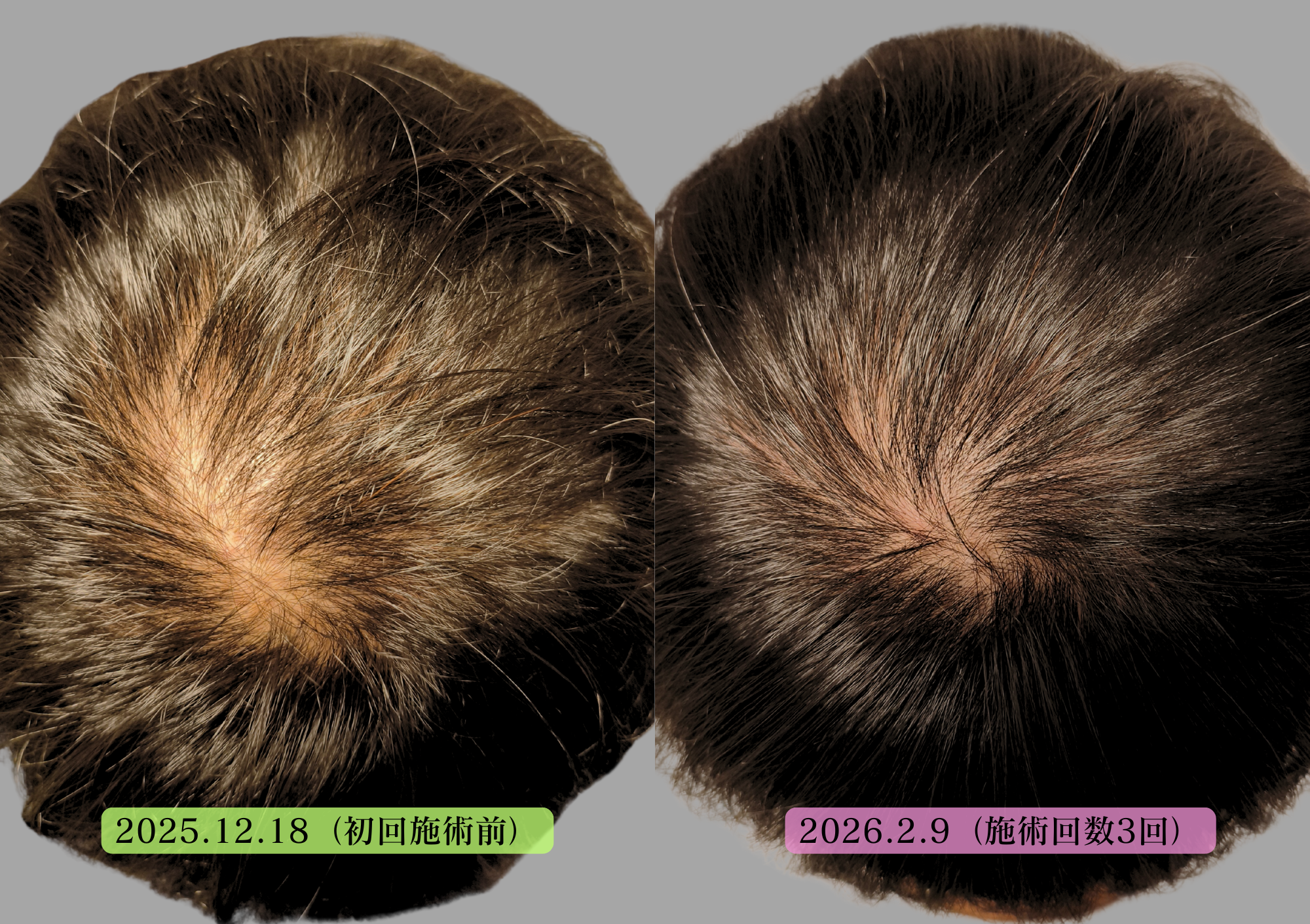 薄毛、抜け毛改善にはやなけん亀戸店の育毛鍼+LED