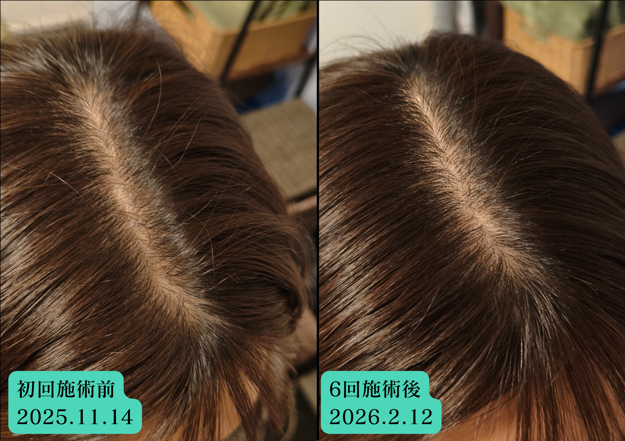 鍼灸サロンやなけん亀戸店の育毛鍼での経過