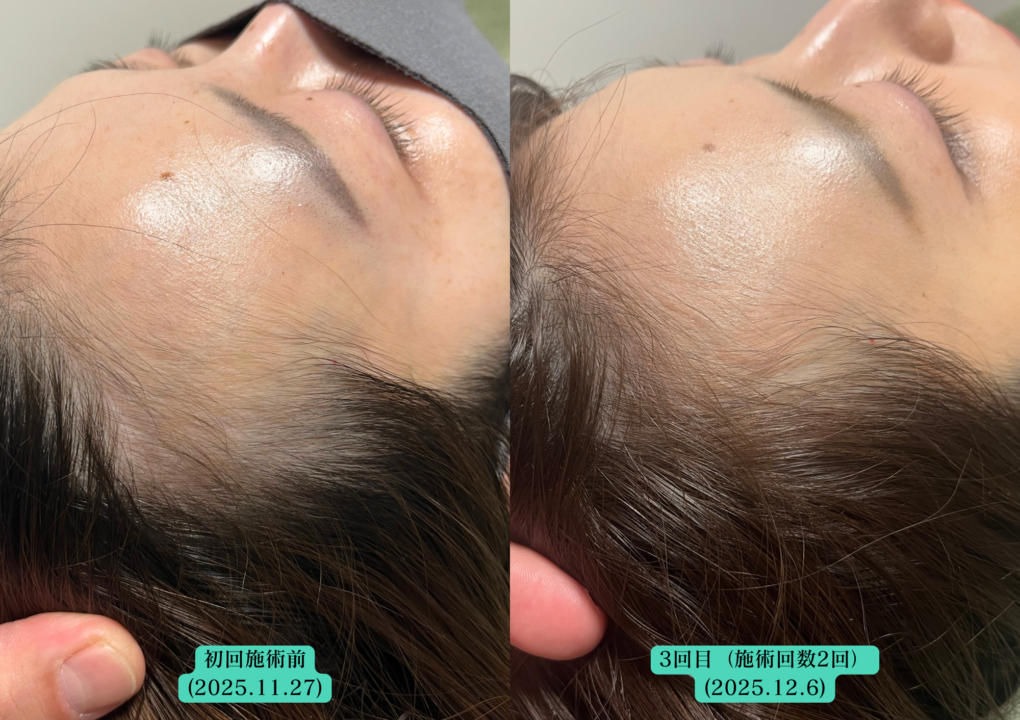 やなけん亀戸店の育毛鍼施術