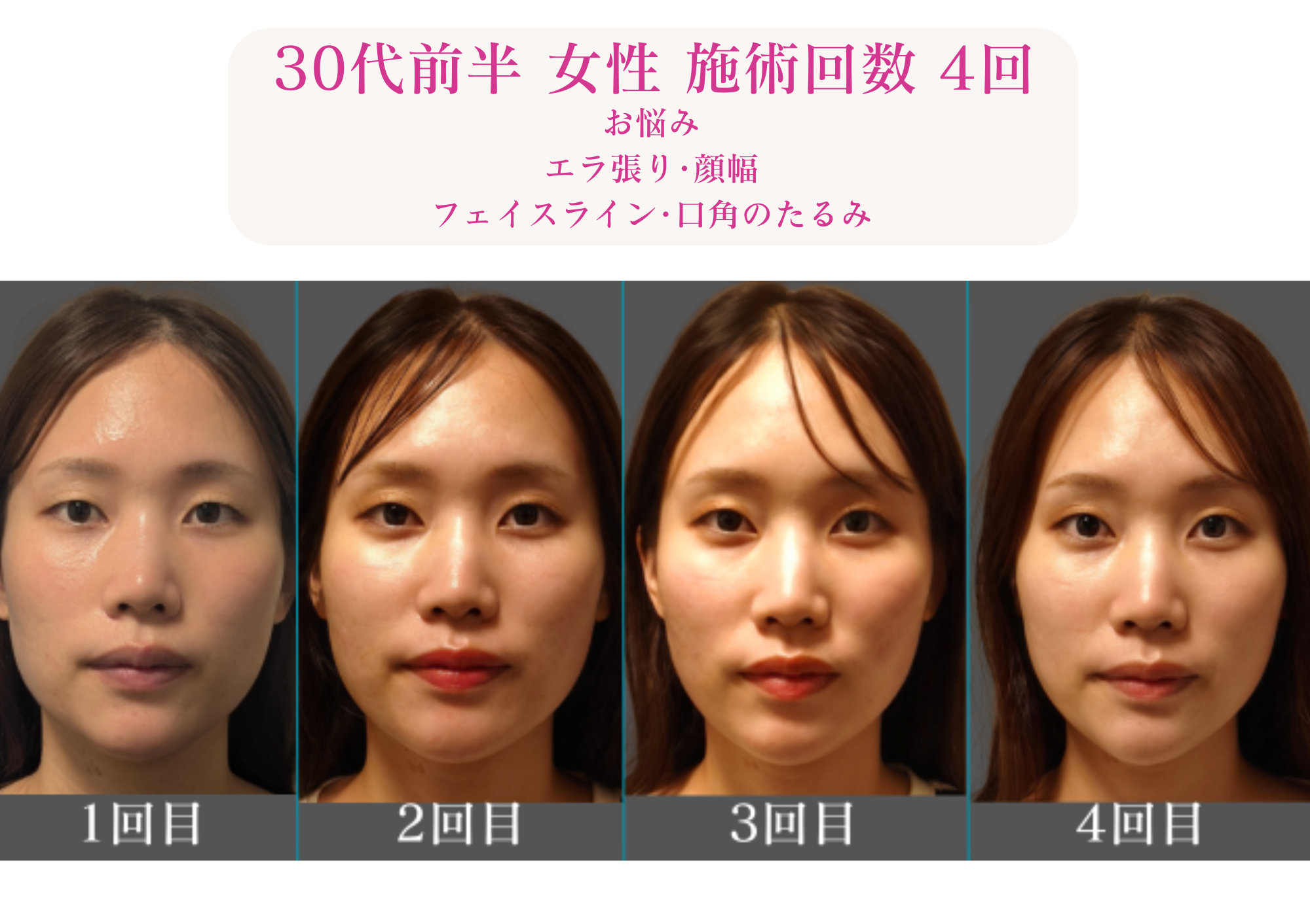 亀戸にある鍼灸サロンやなけんの美容鍼を受けた変化