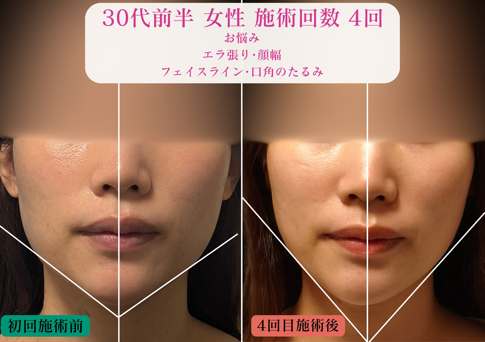 30代女性美容鍼＋LED4回目の変化