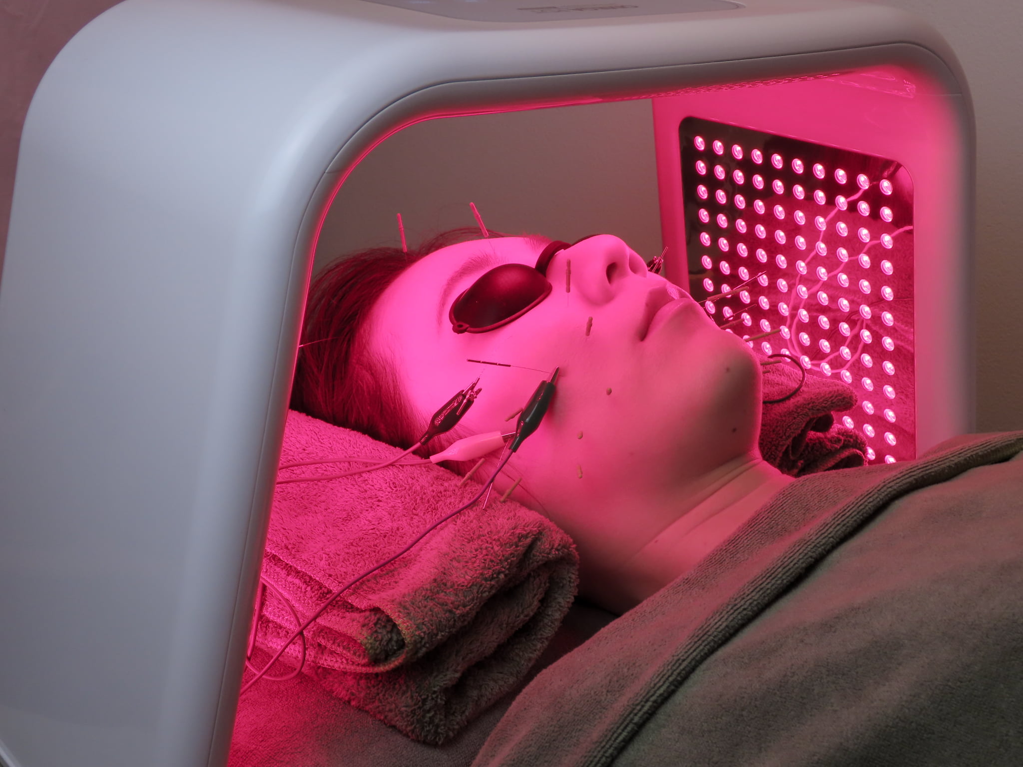 亀戸にある鍼灸サロンやなけんの小顔リフト美容鍼+LED