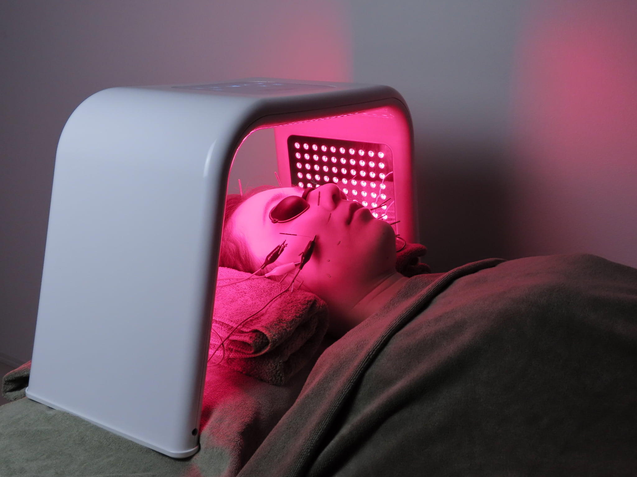 亀戸にある鍼灸サロンやなけんの美容鍼+LEDでたるみ、ほうれい線を改善