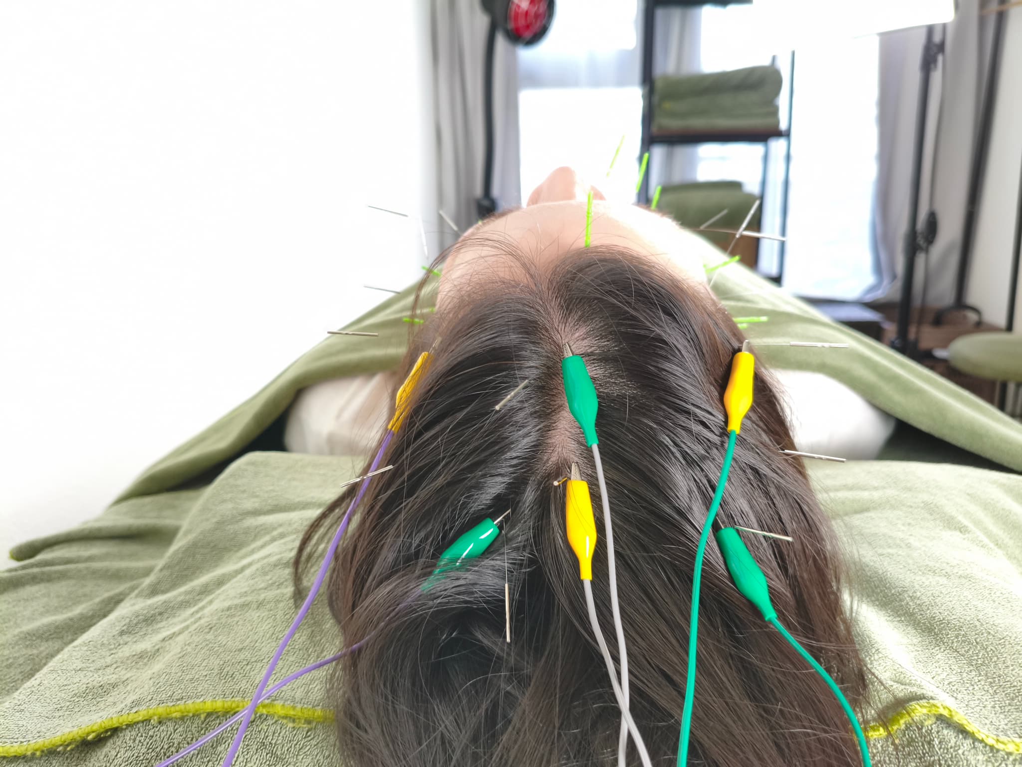 鍼灸サロンやなけん亀戸店の育毛鍼+パルス