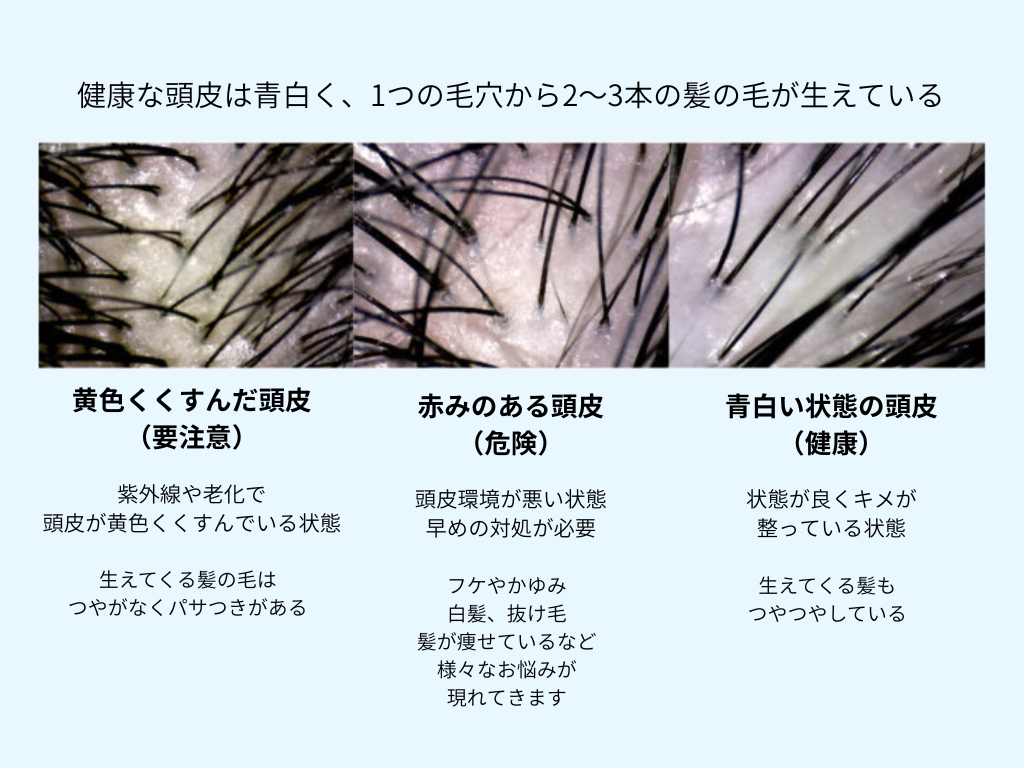 薄毛の原因、育毛には頭皮環境が重要
