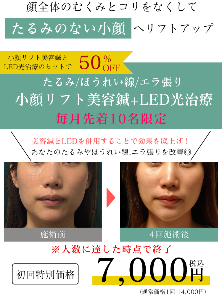 亀戸にある鍼灸サロンやなけん亀戸店の美容鍼+LED