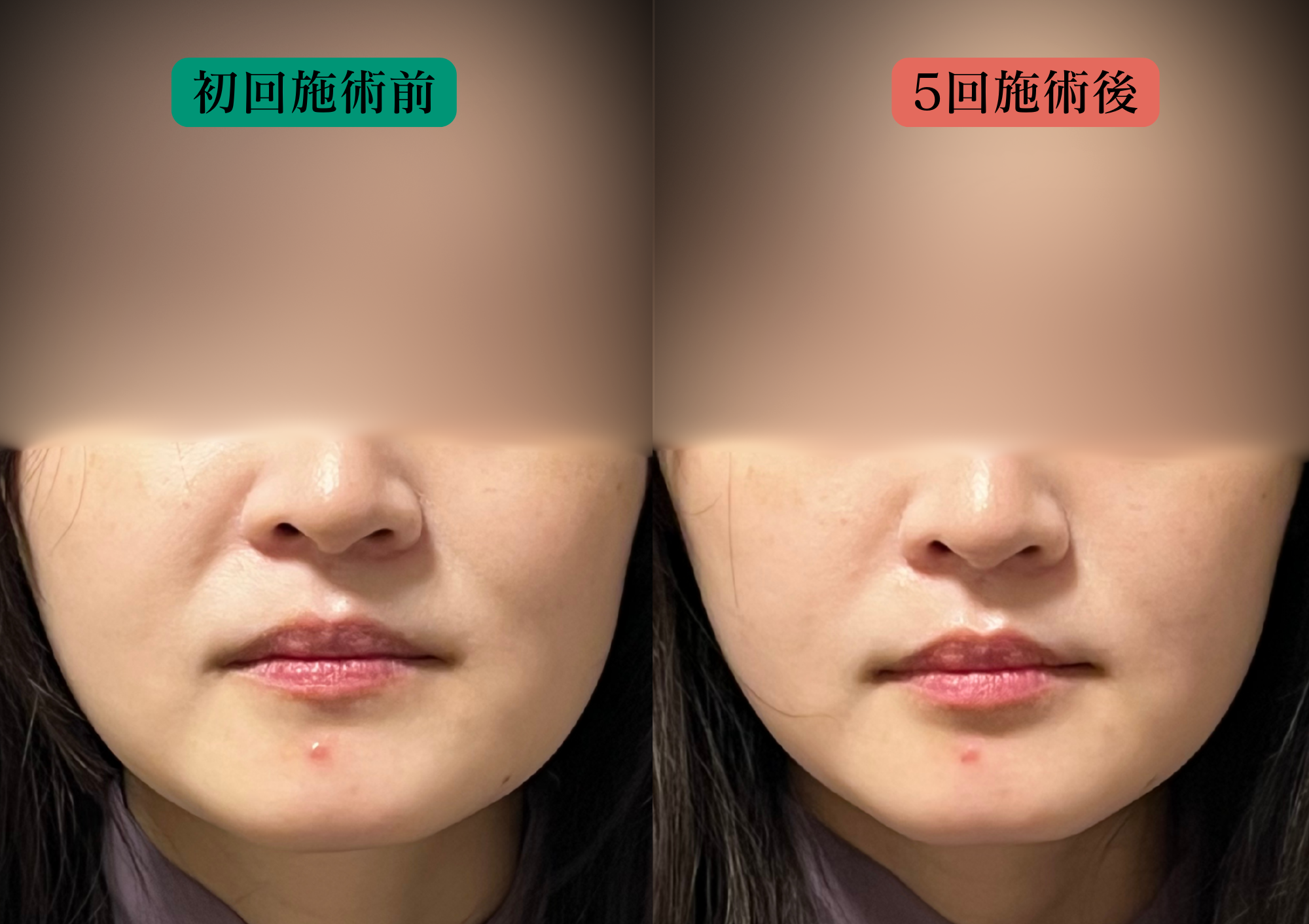 亀戸の鍼灸サロンやなけんの美容鍼での変化