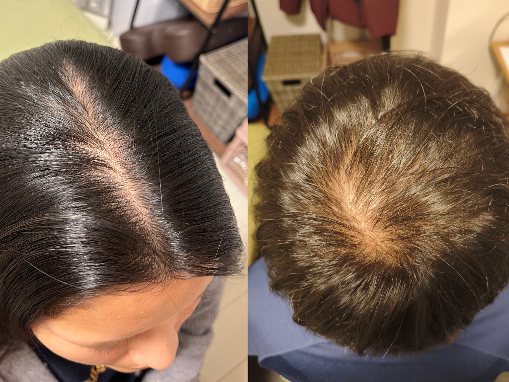 薄毛、受け毛、育毛ならやなけん亀戸店