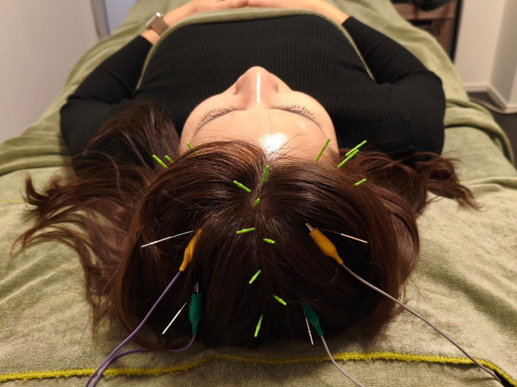 亀戸にある鍼灸サロンやなけんの薄毛改善育毛鍼