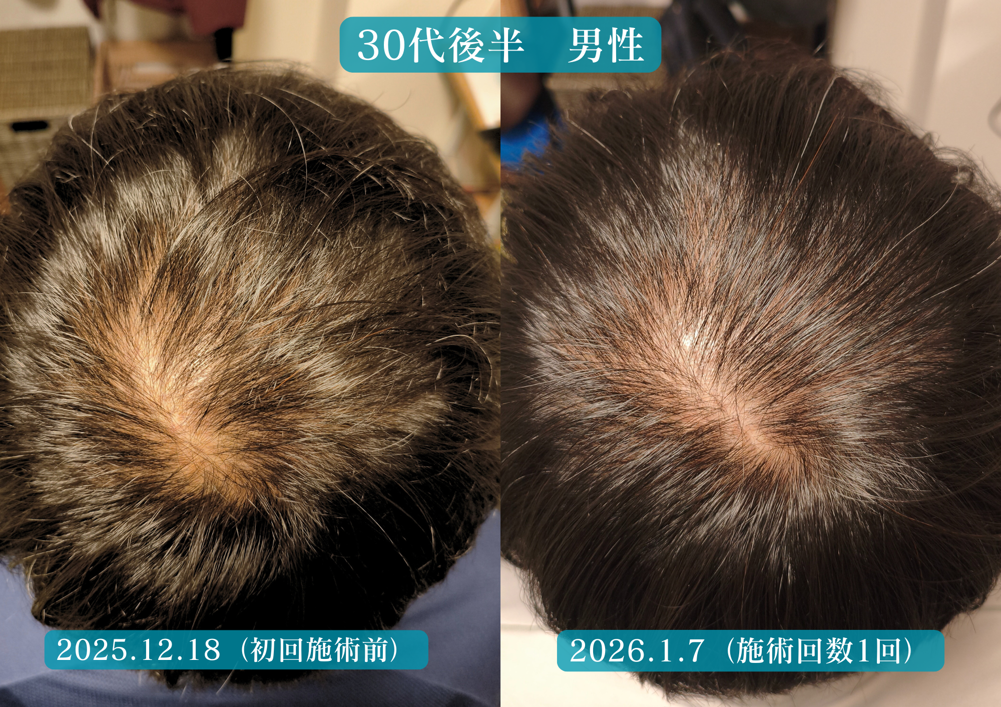 頭頂部の薄毛、ボリューム低下に悩む頭皮の経過写真 1か月時点