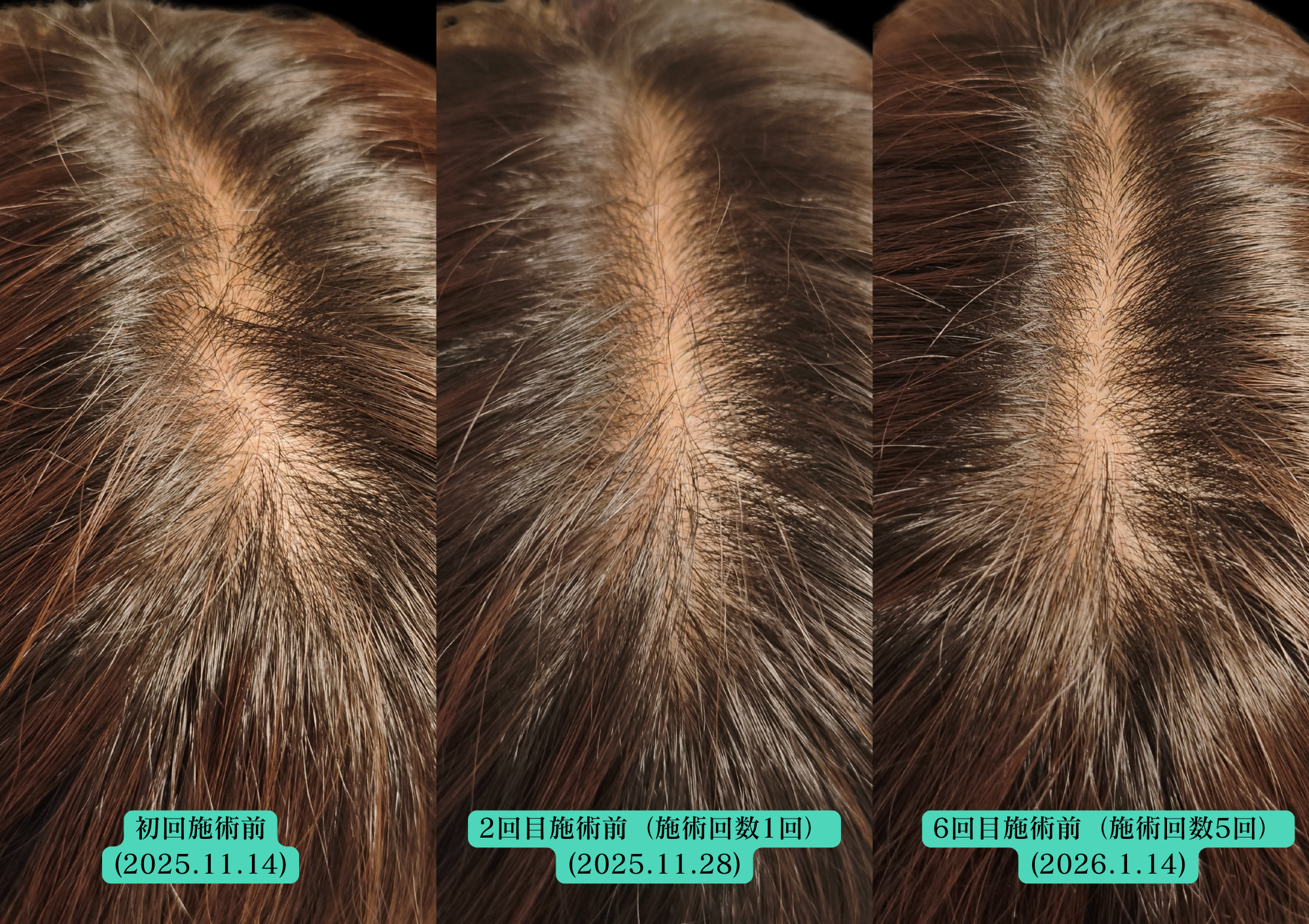 薄毛、抜け毛、分け目が目立つお悩みに育毛鍼