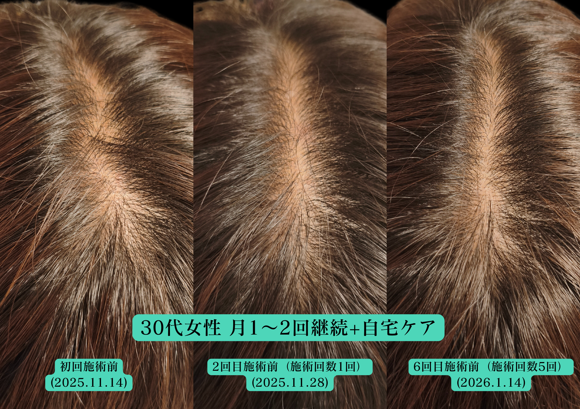 薄毛、抜け毛改善にはやなけん亀戸店の育毛鍼+LED