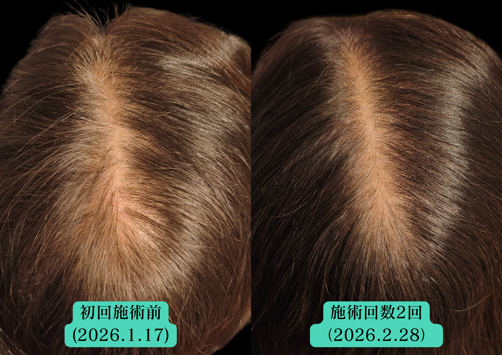 鍼灸サロンやなけん亀戸店の育毛鍼での経過