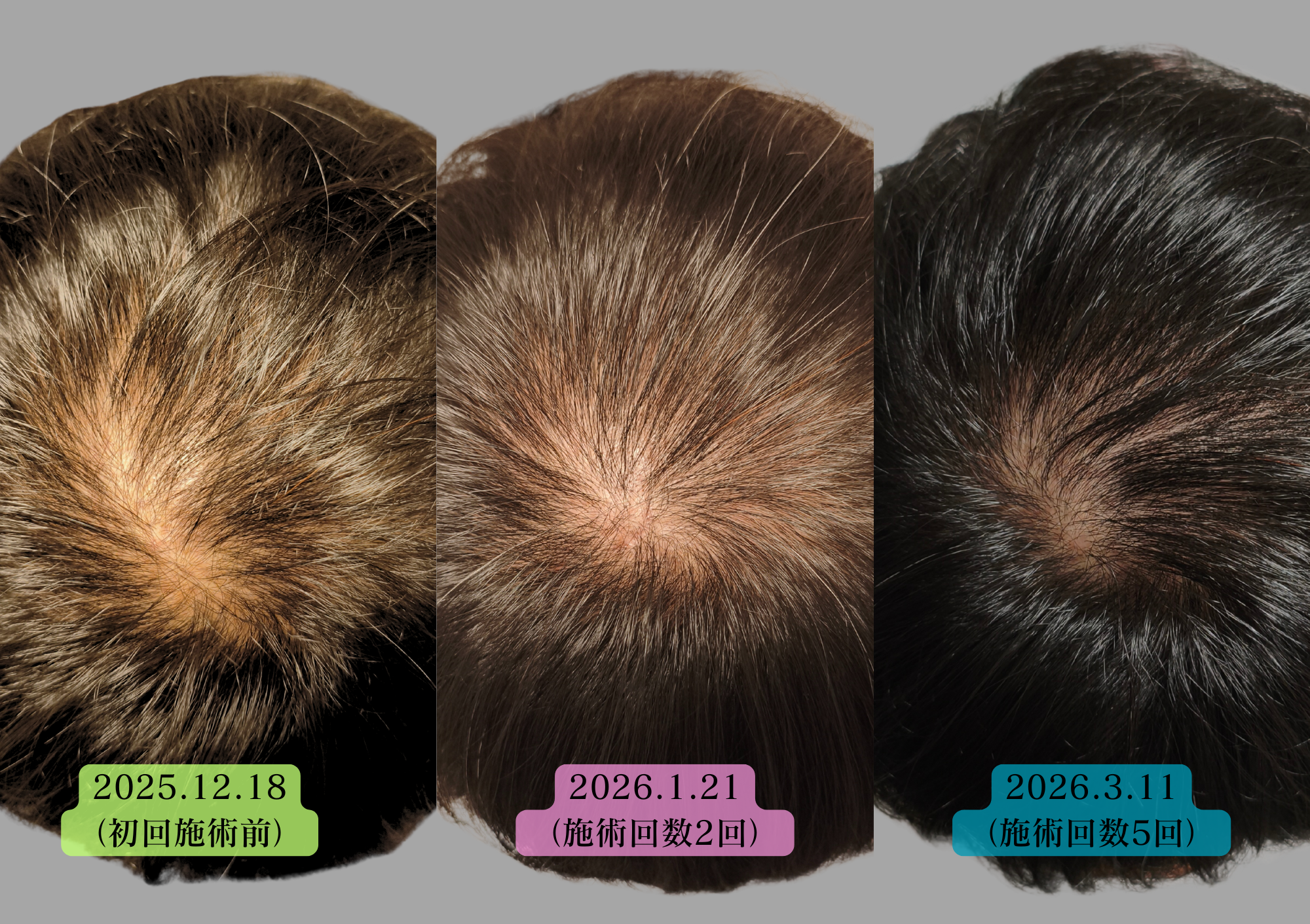 薄毛、AGAのお悩みにはやなけん亀戸店の育毛鍼