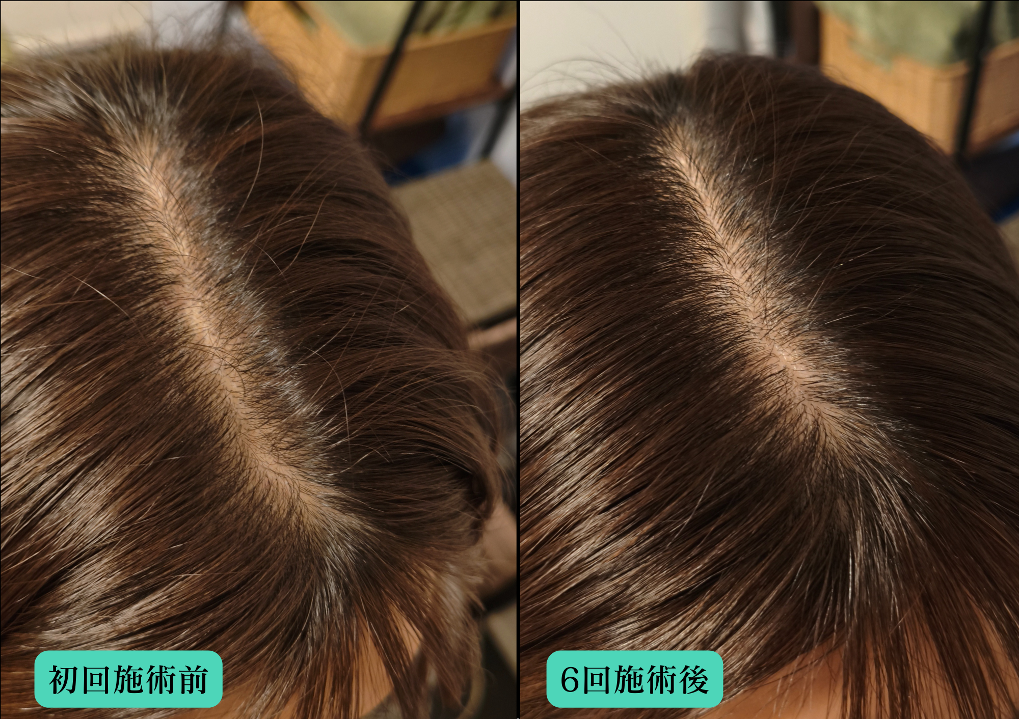 鍼灸サロンやなけん亀戸店の育毛鍼での経過