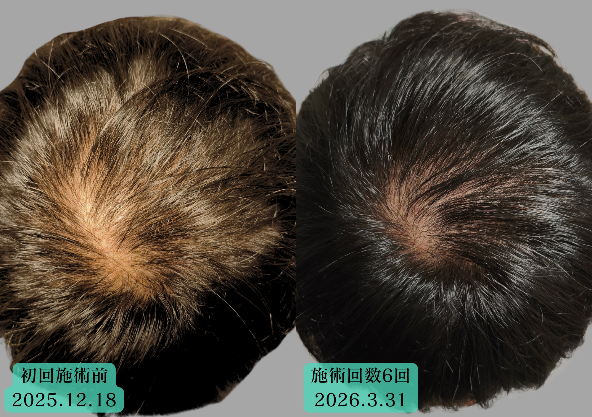30代男性育毛鍼での経過