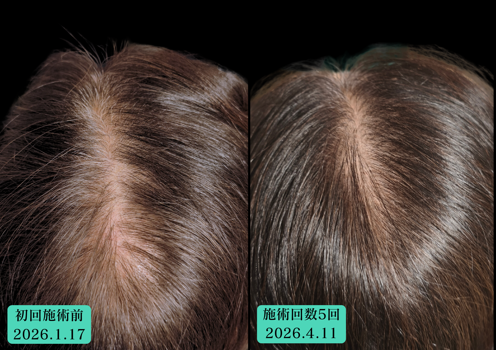 50代女性、育毛鍼での経過