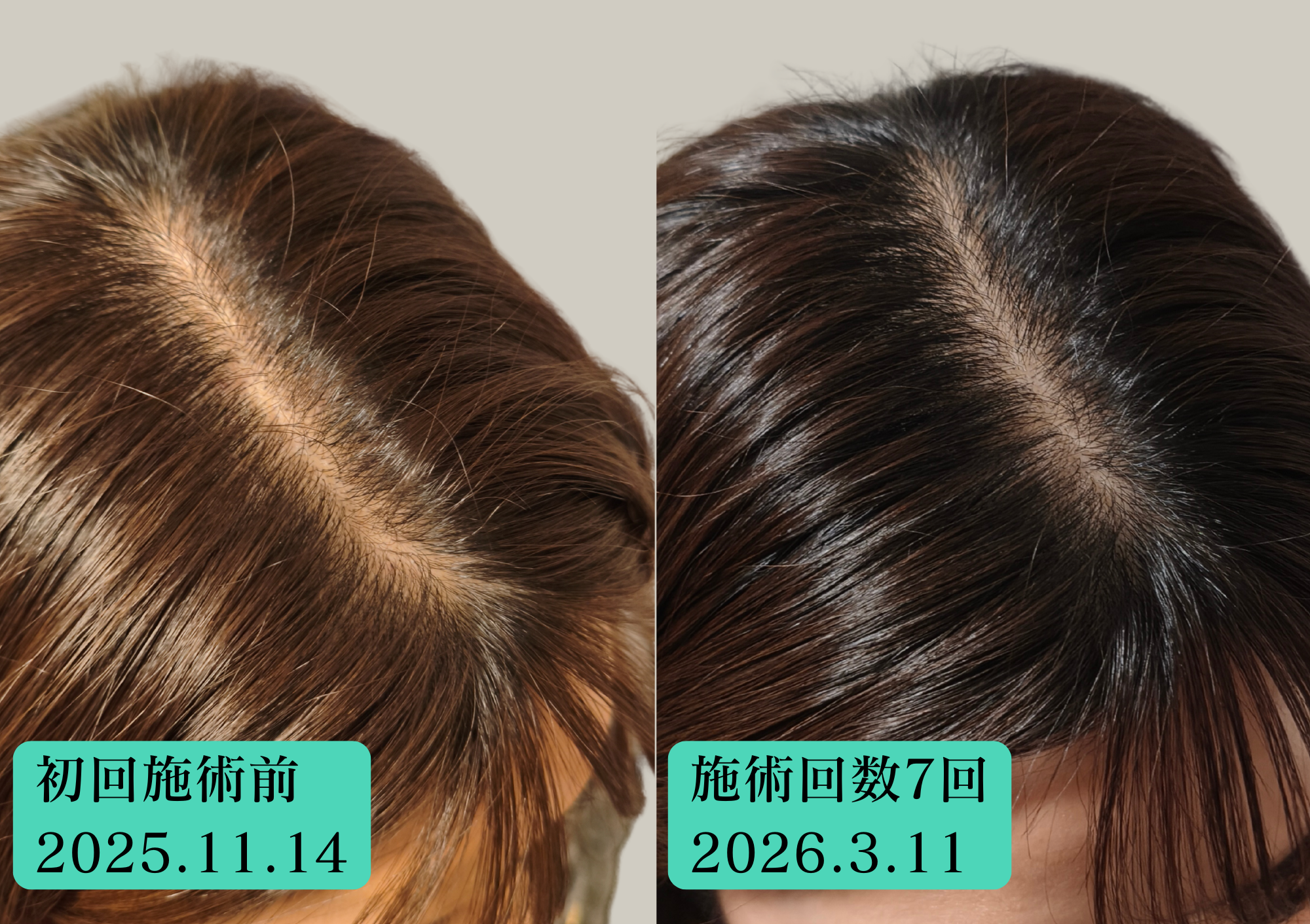 30代女性育毛鍼での経過