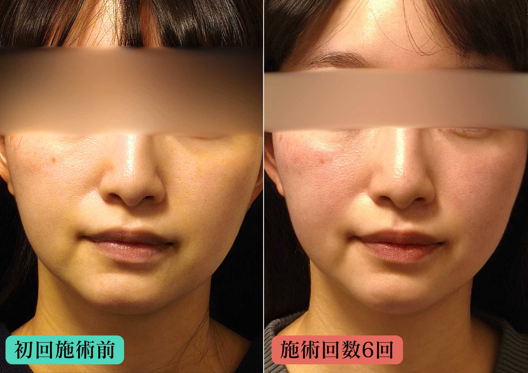 美容鍼+LEDでの経過（6回施術）