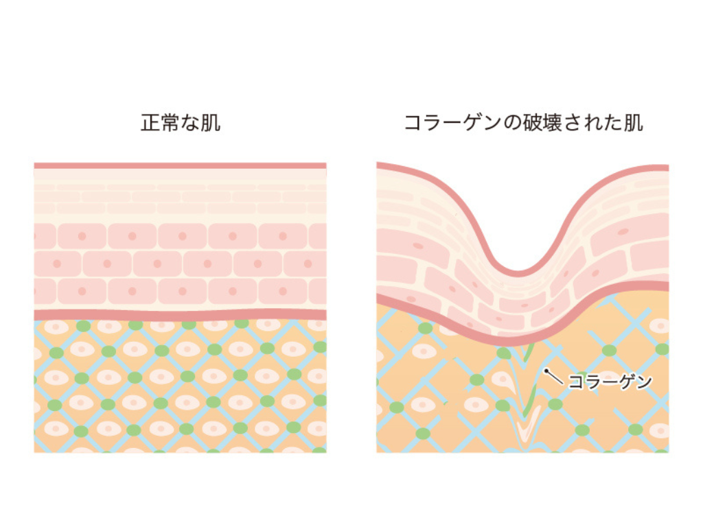 たるみの原因はコラーゲンの減少