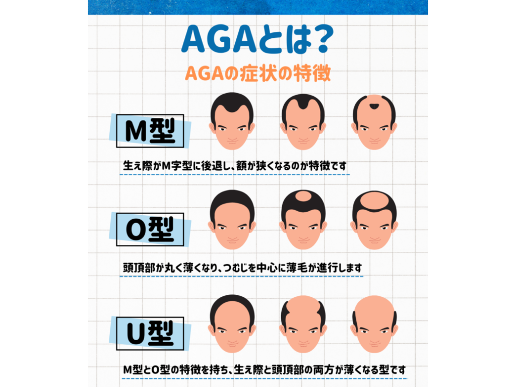 AGA(男性型薄毛)とは?