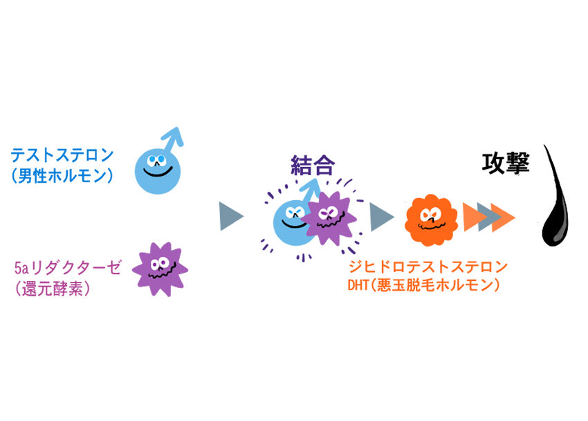 AGA(男性型薄毛)