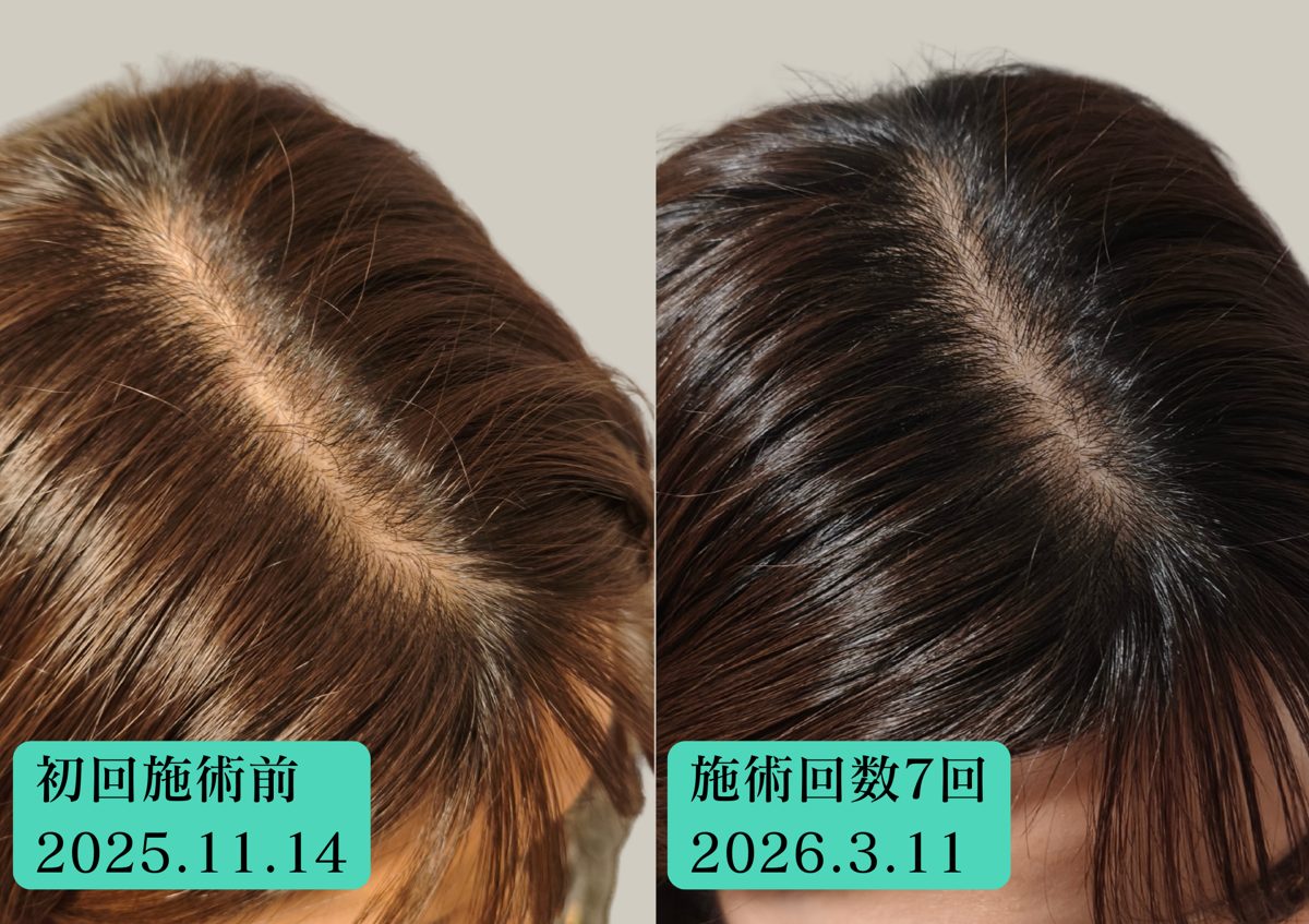 30代女性 分け目 初回と施術7回目の比較
