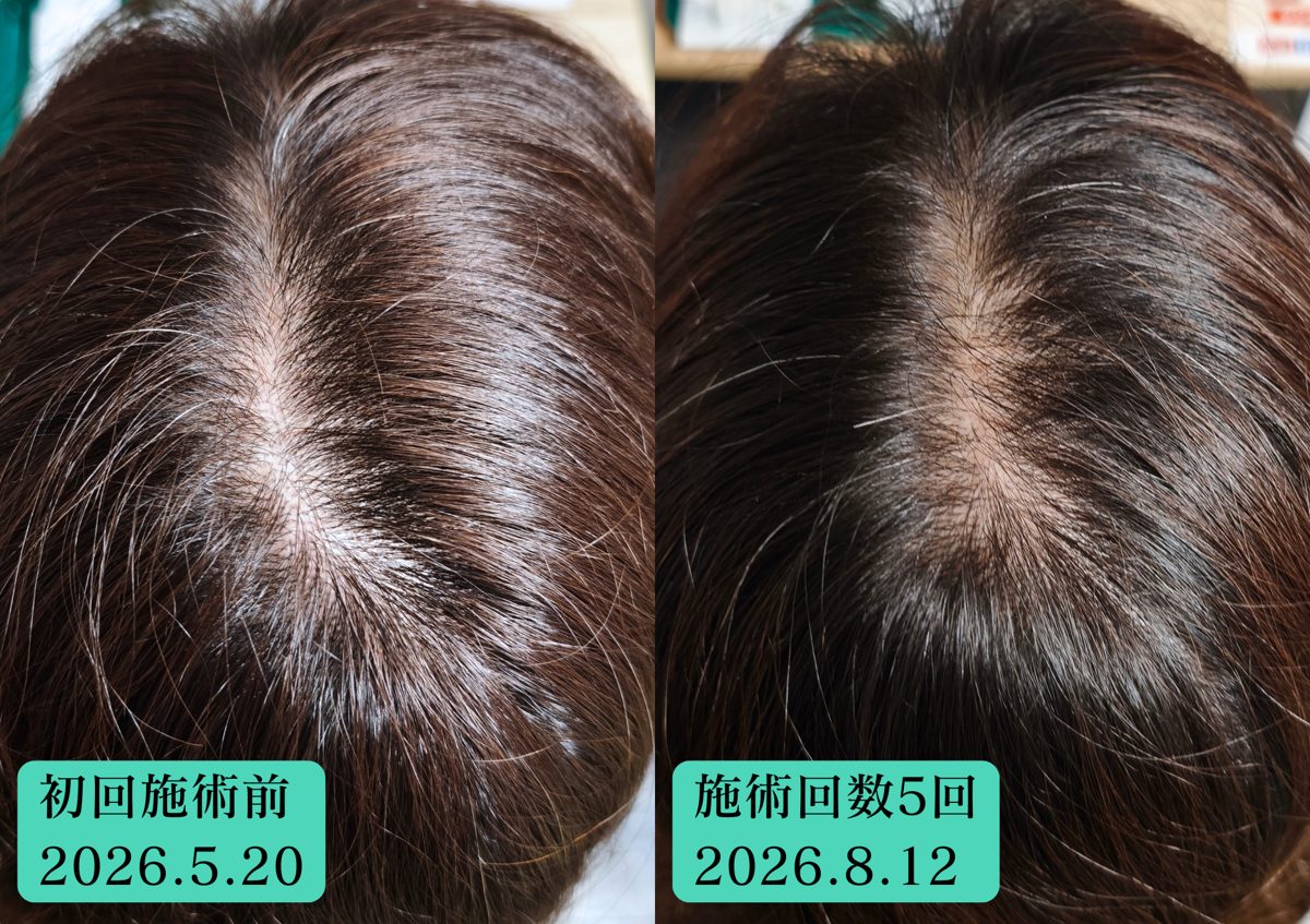 50代女性 分け目 初回と施術5回目の比較